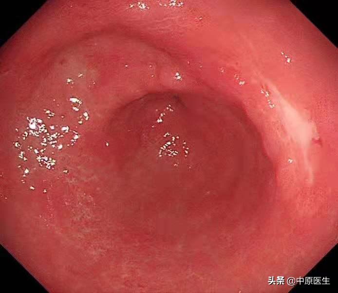 胃部怀疑是溃疡，细心专家又选择窄带光放大检查发现是胃癌