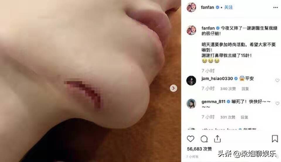 范玮琪摔伤后的图片,范玮琪摔跤最新消息