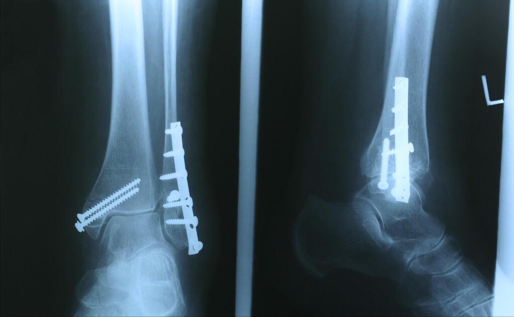 骨折后保守治疗需要注意什么,骨折手术有几种固定方法