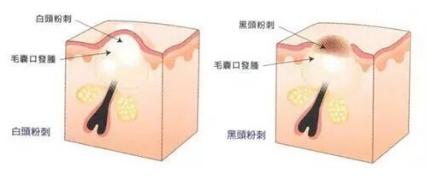 毛孔粗大有黑头适合什么粉底液,遮盖粗大毛孔黑头用什么粉底液