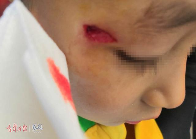 6岁男童在幼儿园磕伤眼角，最新进展：家长与园方达成一致