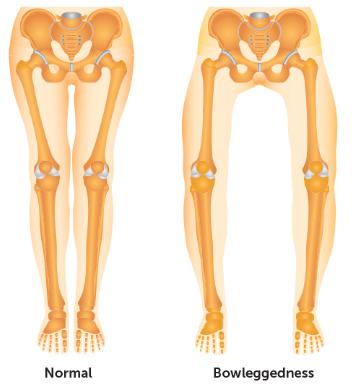 o型腿膝外侧关节疼痛,o型腿膝盖疼最好锻炼方法