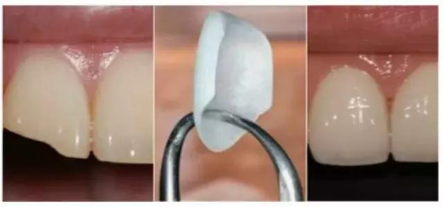 前牙磕掉一个小尖怎么修复,换过的牙磕掉了一小块怎么修复