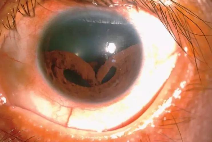 男子生殖器自燃的新闻,男性生殖器着火