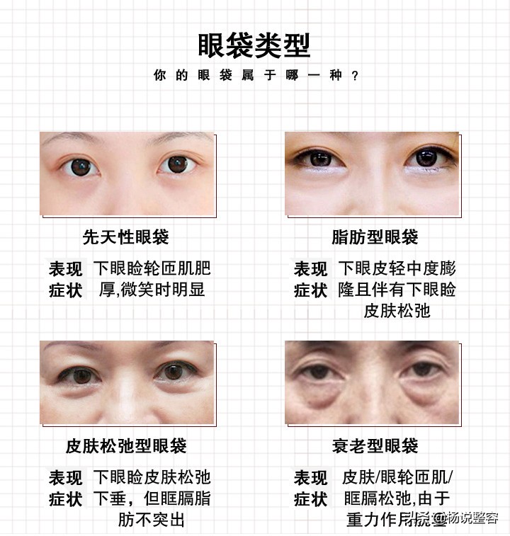 眼袋不仅难看,还特别显老,那么哪种去眼袋方法比较好呢?