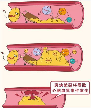 血栓辟谣,经常运动血栓