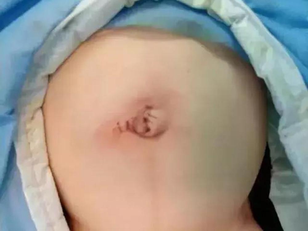 宝宝肚脐肿,宝宝肚脐有点肿怎么回事