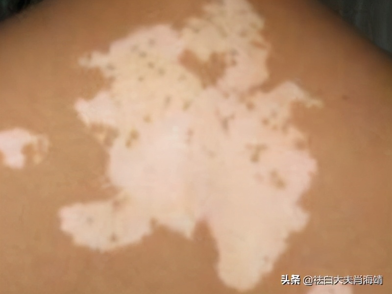 白癜风没有用药自己好了,白癜风不吃药在家怎么处理