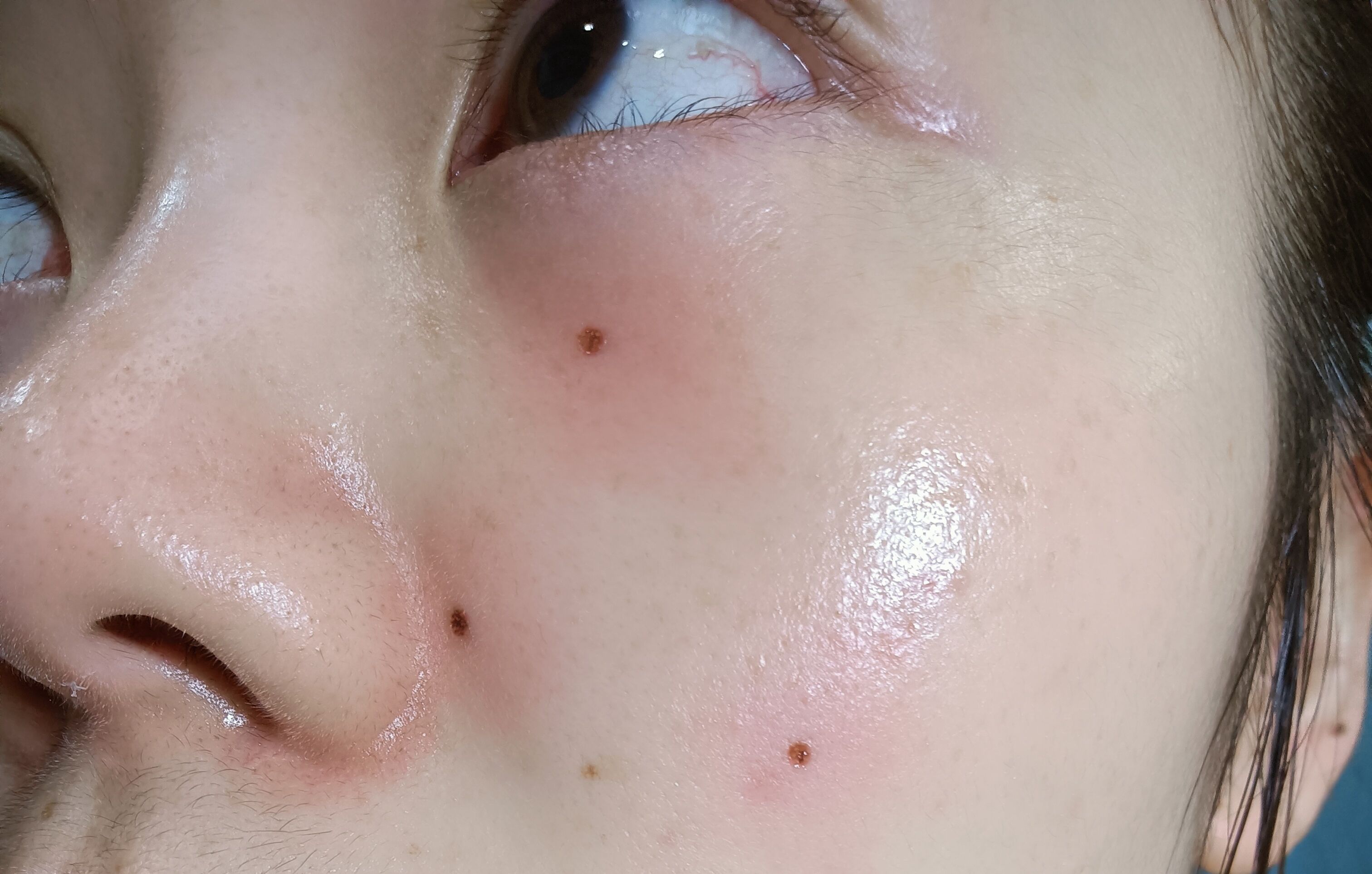 痣多适合什么点痣方法,点痣小妙招一秒点好一个美人痣