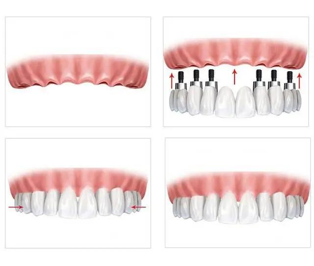 种牙怎么选专业医生,老牌种牙