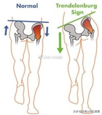 运动膝关节疼痛自我治疗方法,髌骨疼痛综合征康复训练