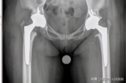 髋关节置换择期手术,南溪区第一例髋关节置换手术
