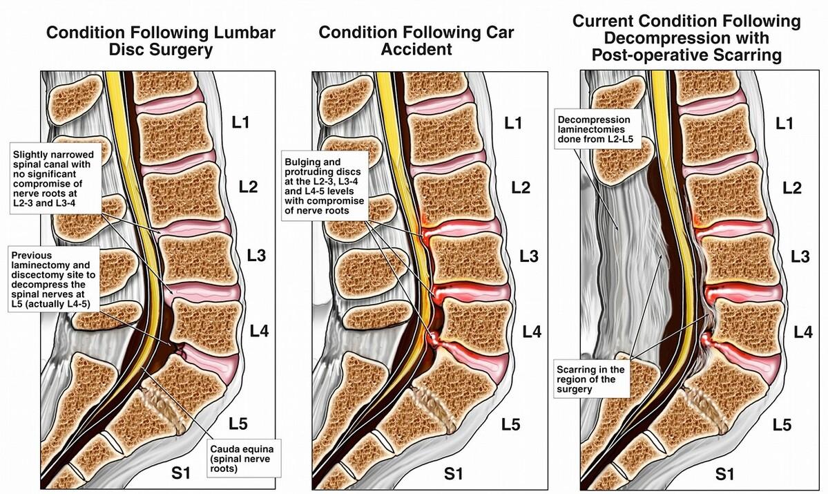 80多岁的老太太，腰痛5天不能走了，医生：边检查边治疗