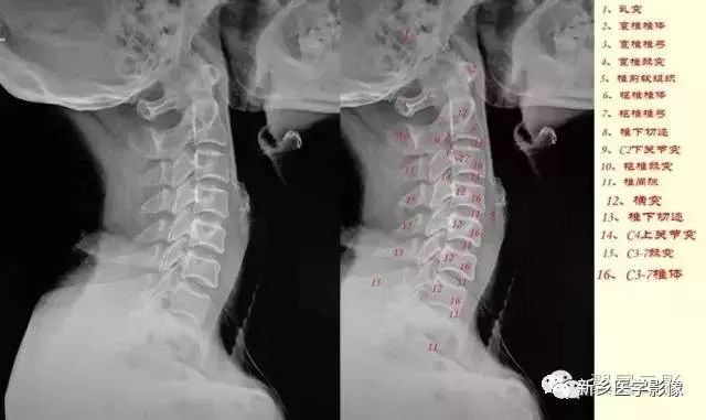 肘关节x线解剖,颈椎x线图片与讲解大全