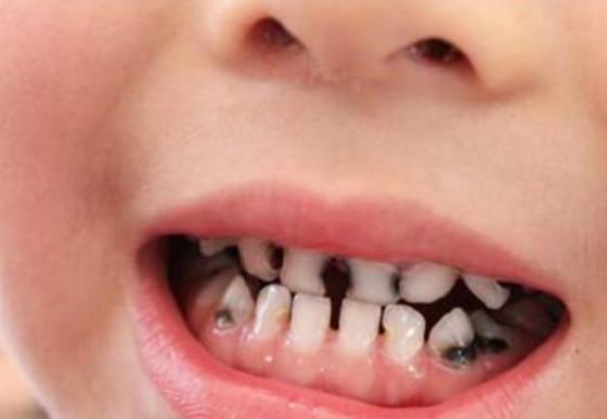 四岁儿童有黑牙怎么办,3岁儿童满口小黑牙元凶并不是糖