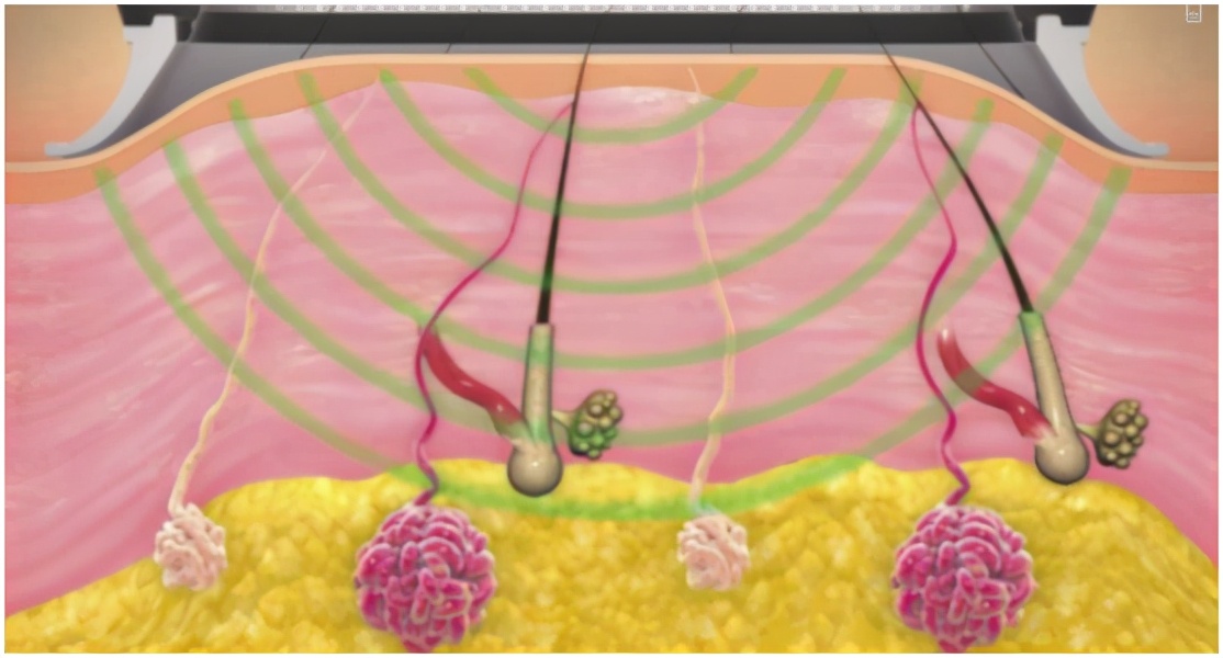 引起狐臭的真正原因到底是什么,狐臭是什么特征引起的怎么治疗