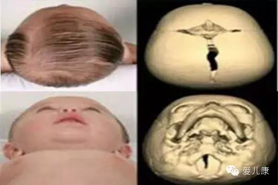婴儿头型睡偏了几个月纠正来得及,如何防止宝宝头型睡偏