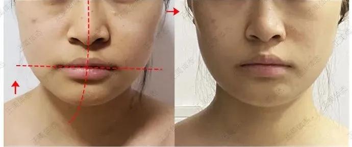 下巴歪斜矫正图,下颌紊乱大小脸矫正