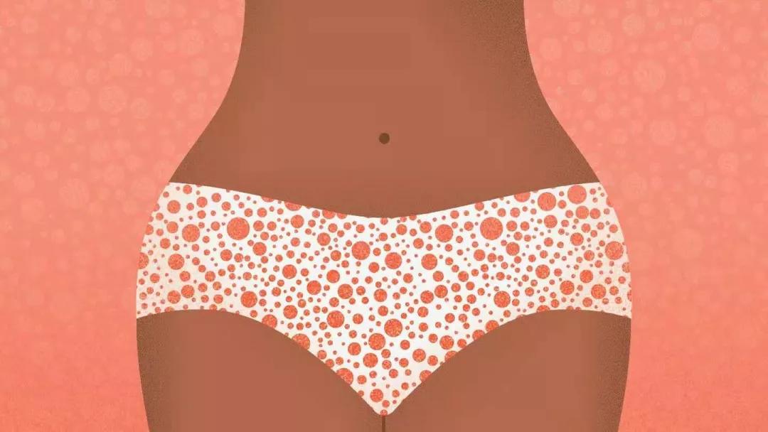 得了生殖器疱疹真的那么可怕吗,生殖器疱疹真那么可怕吗