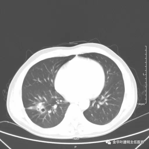 伴有脑转移了的肺癌能手术吗?