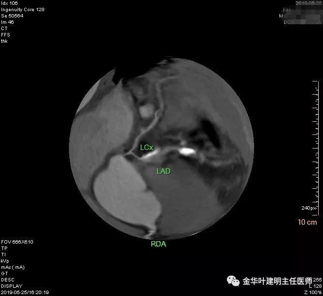 手术引起乳糜胸,有没有做了肺结节手术后是误诊的