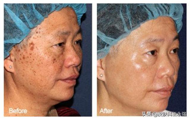 老年斑消除最好的方法皮肤科,长了老年斑怎么食疗