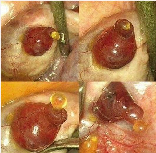 卵巢突然不排卵是怎么回事,卵巢不排卵女性就老了