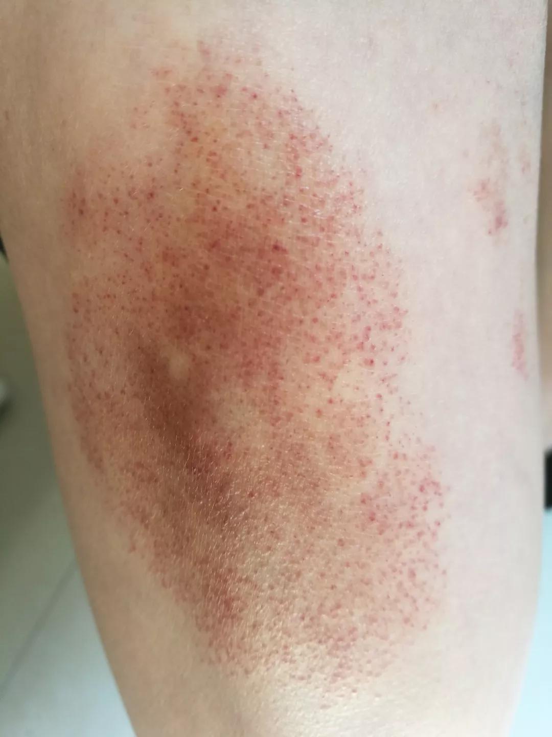 色素性紫癜性皮肤病是啥,色素性紫癜性皮肤病是什么