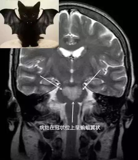 脱髓鞘病变是什么病怎么读,脱髓鞘病变的特征