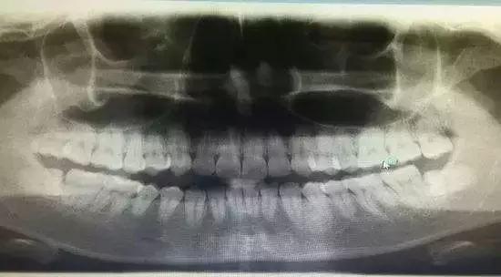 盘点那些看着都很疼的拔牙方法,拔牙过程的操作步骤及注意事项