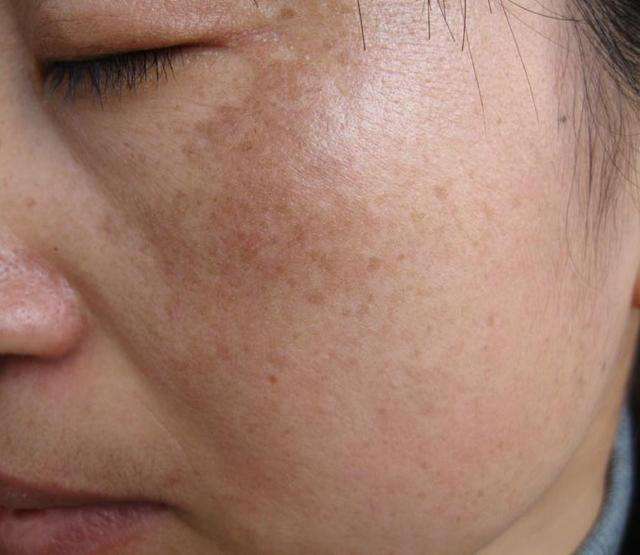 脸上的斑去哪里能看出是什么斑,脸上斑的分类及形成原因