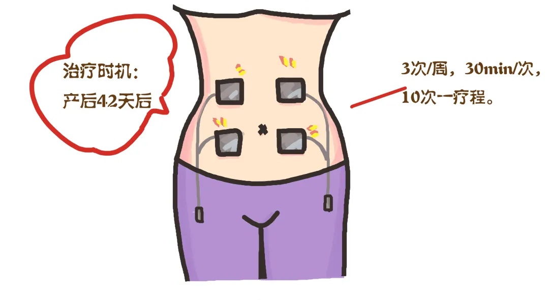 生完孩子我的水桶腰怎么办？