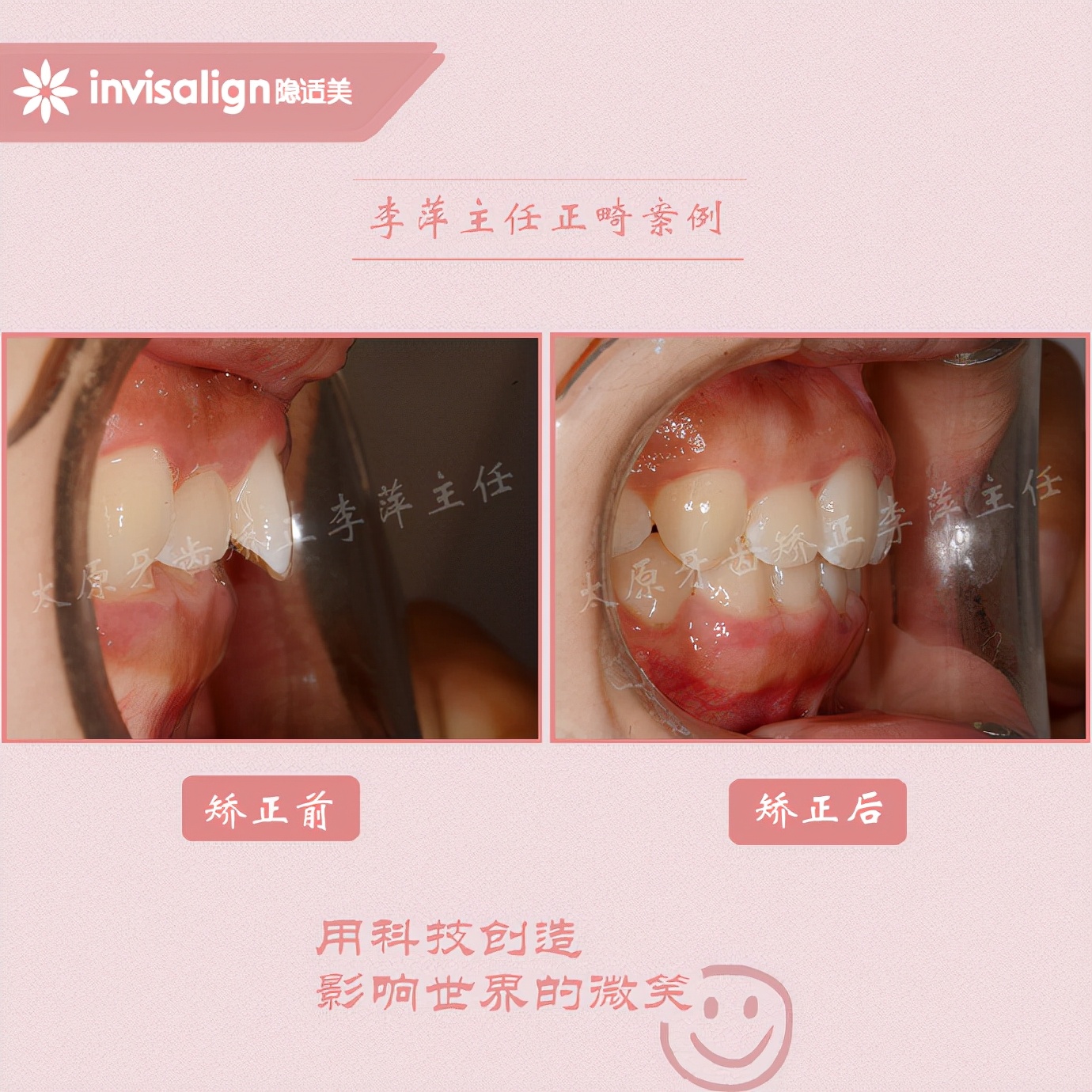 太原牙齿隐形矫正,太原牙齿正畸贵吗