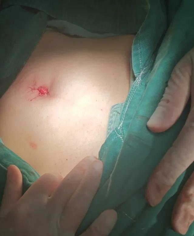 从“微创”到“无痕”~长汀妇幼妇科团队成功完成两例单孔腹腔镜手术!小切口大世界……