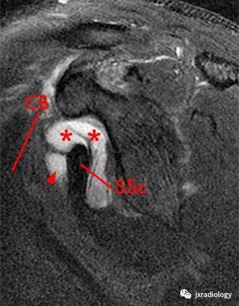 肩关节周围滑囊有哪些,肩关节滑囊疝严重吗