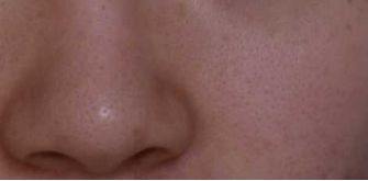 打败毛孔!下一个反孔精英就是你!