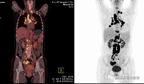 肺癌淋巴结转移和淋巴癌区别,肺和气管之间有恶性淋巴转移