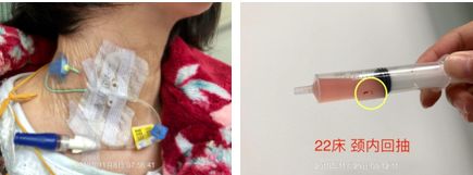 中心静脉导管抽回血的正确方法,静脉抽不出来血怎么办