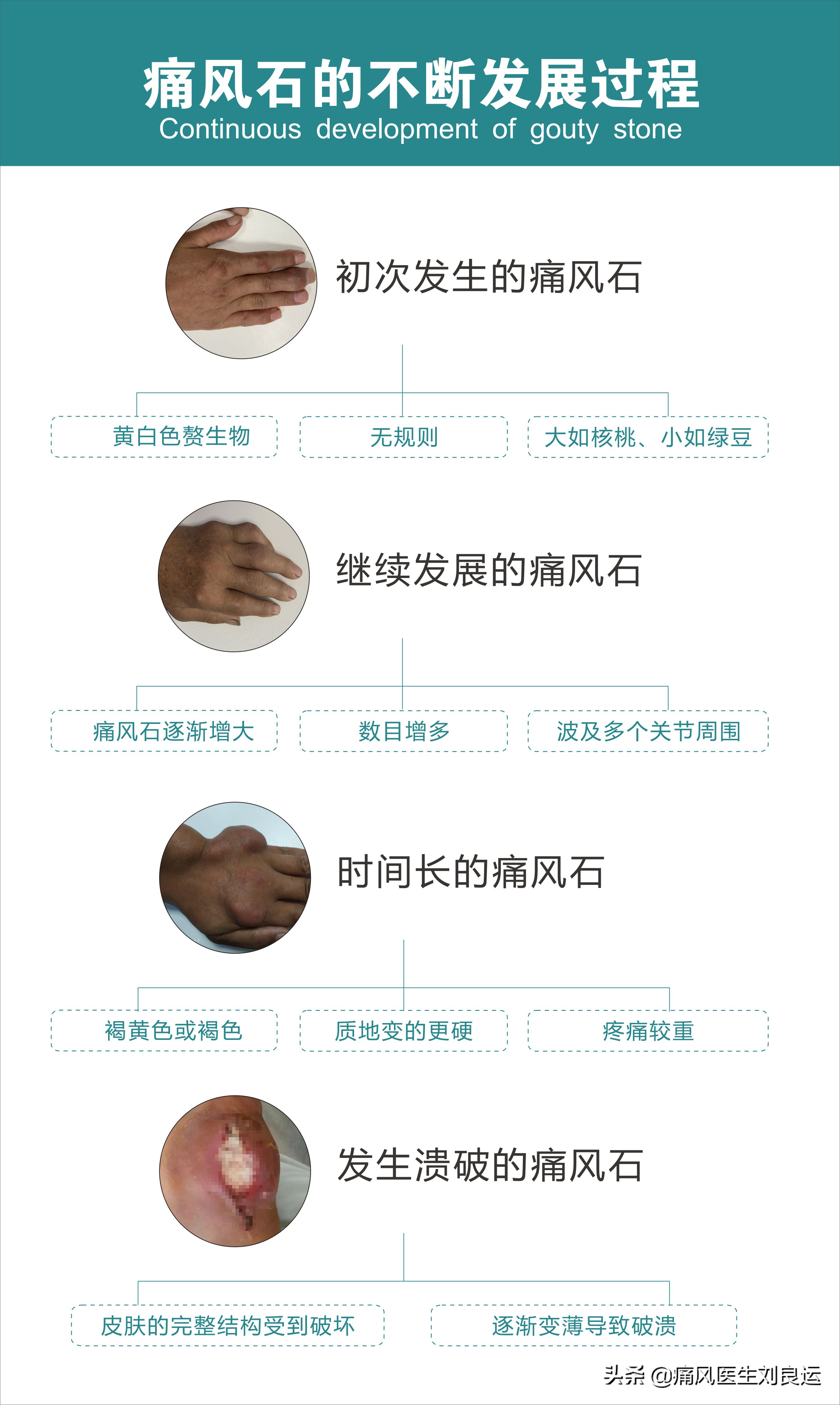 痛风富贵病,饮食很清淡但犯痛风了