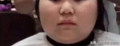 蘑菇怎么变成鹅蛋脸,国字脸磨骨成瓜子脸多少钱