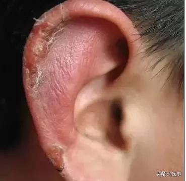 专治冻疮特效穴,冻疮有特效膏药吗