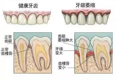 牙缝1cm太大医生说补不了,牙缝上面细下面大能补吗