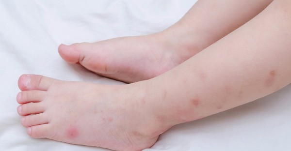 宝宝脖子上的痱子起脓包,痱子发红是快好了吗