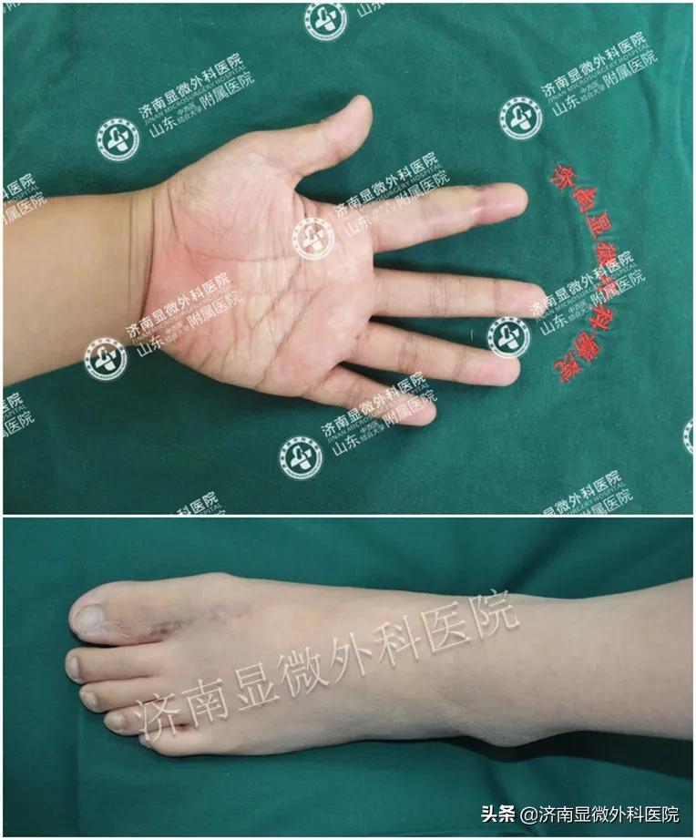 手指少了一块肉怎么处理,手指少了一截