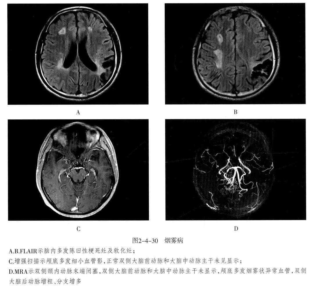 颅内血管轻度狭窄诊断标准,颅内血管先天变异影像