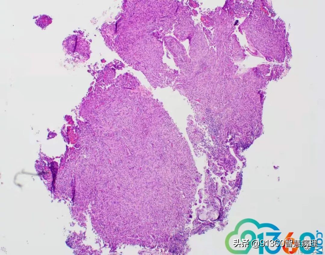 宫颈腺癌silvaa型用化疗吗,宫颈腺癌silvab型需要放疗几次
