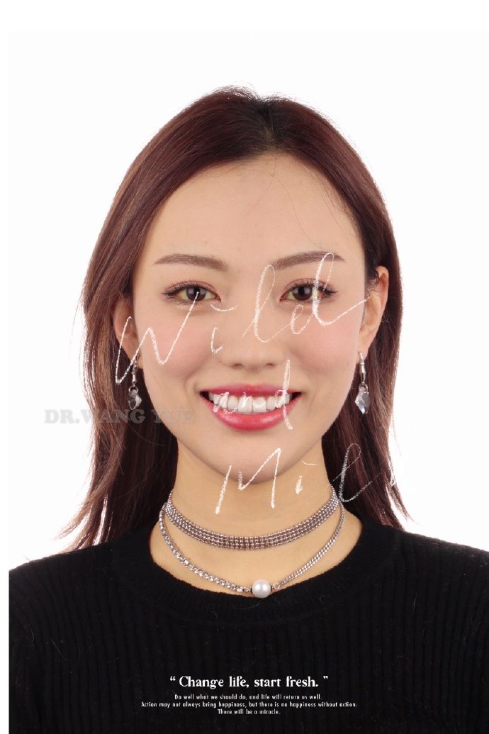 上海牙齿矫正：“小唐嫣”牙套毕业写真照