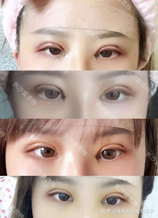 割双眼皮几毫米最好看,割双眼皮真的会好看吗