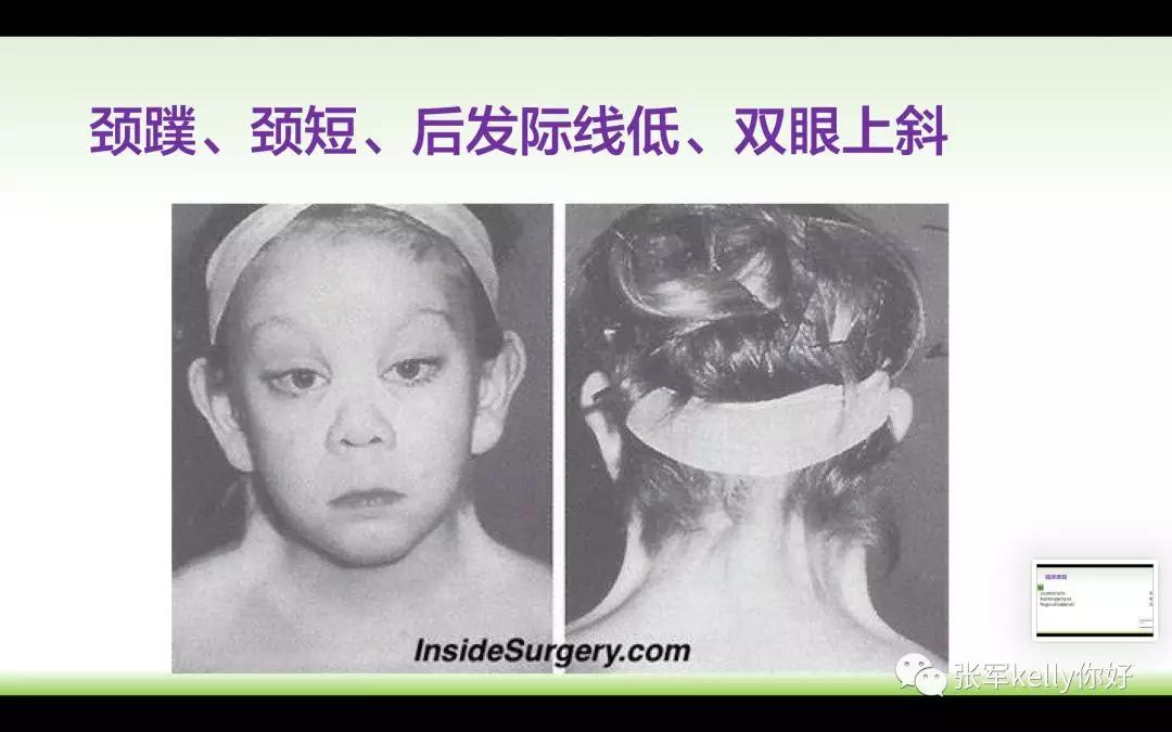 Turner综合征的指南学习