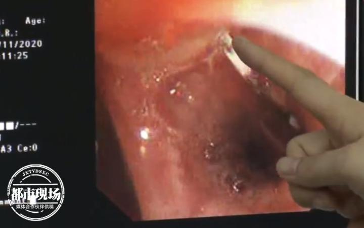 男子治牙结果4厘米针头掉进气管几天后他开始不停咳嗽